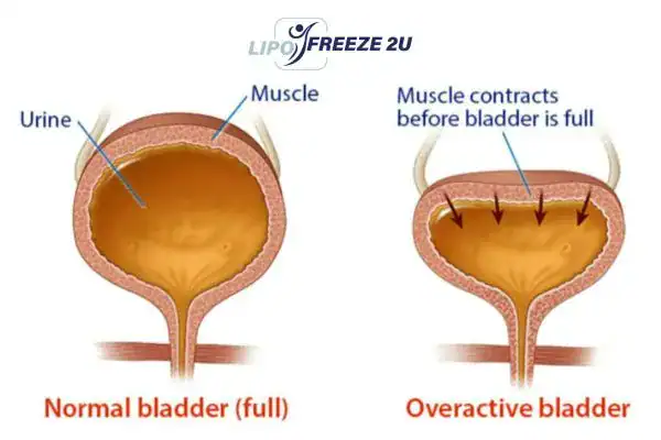 diagram of overactive bladder treatment Yeovil