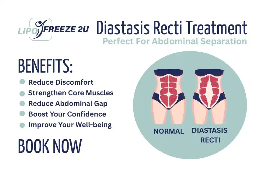 How Long Will It Take to See Improvements in Diastasis Recti Yeovil