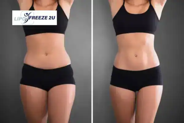 How Can LIPO FREEZE 2U Support Your Post-Pregnancy Body Recovery Yeovil?
