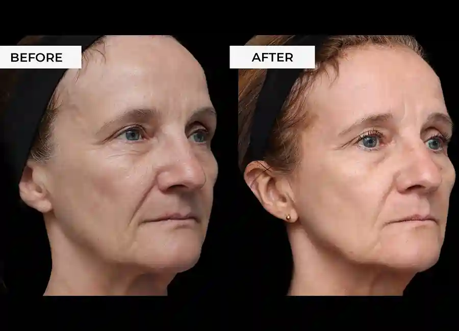 How Many RF Microneedling Sessions Will You Need to See a Difference Yeovil?