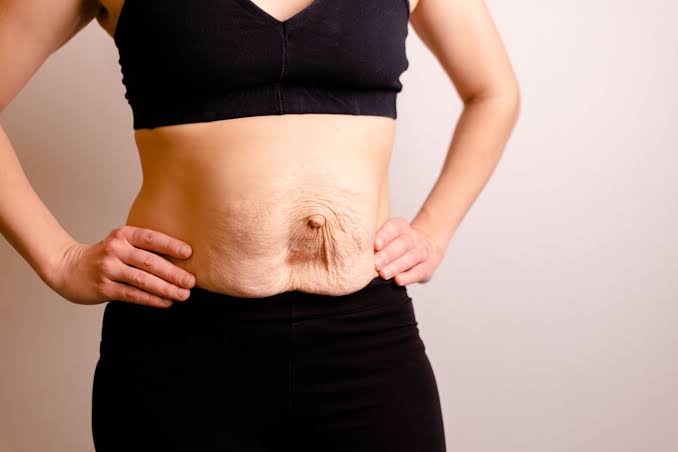 Is Surgery Really the Only Way to Repair Diastasis Recti Yeovil?