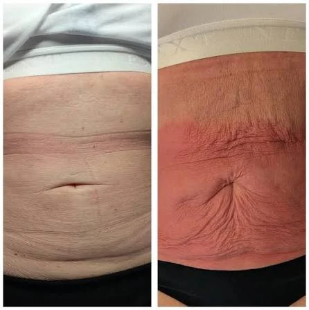 How Does RF Microneedling Improve Crepey, Thin and Uneven Skin Texture Yeovil?