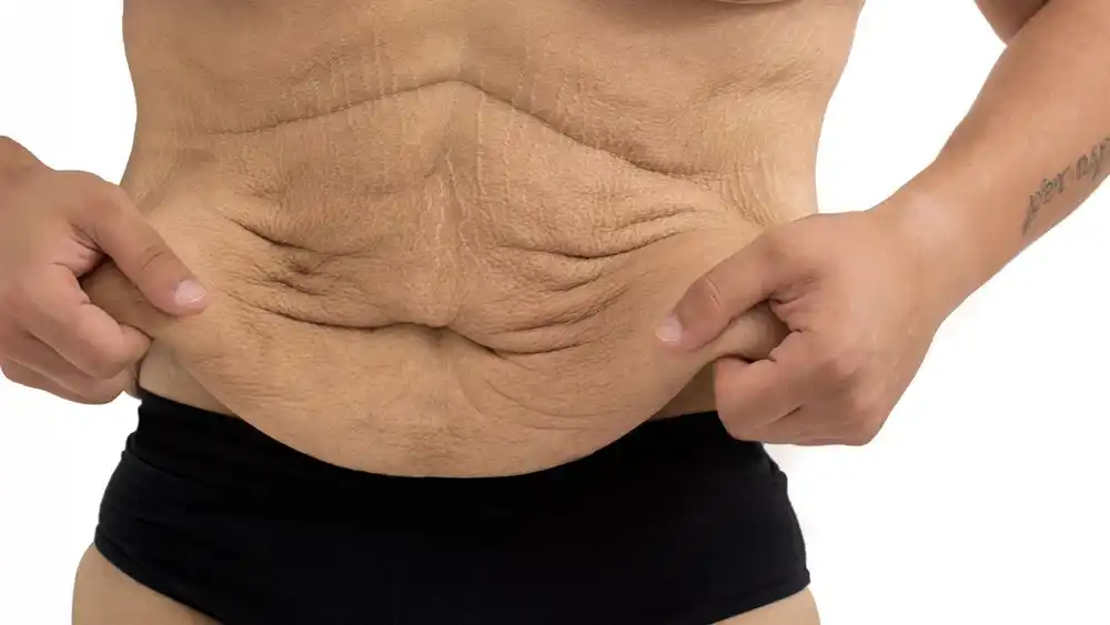 Why Does Weight Loss Medication Leave Some People With Loose or Sagging Skin Yeovil?